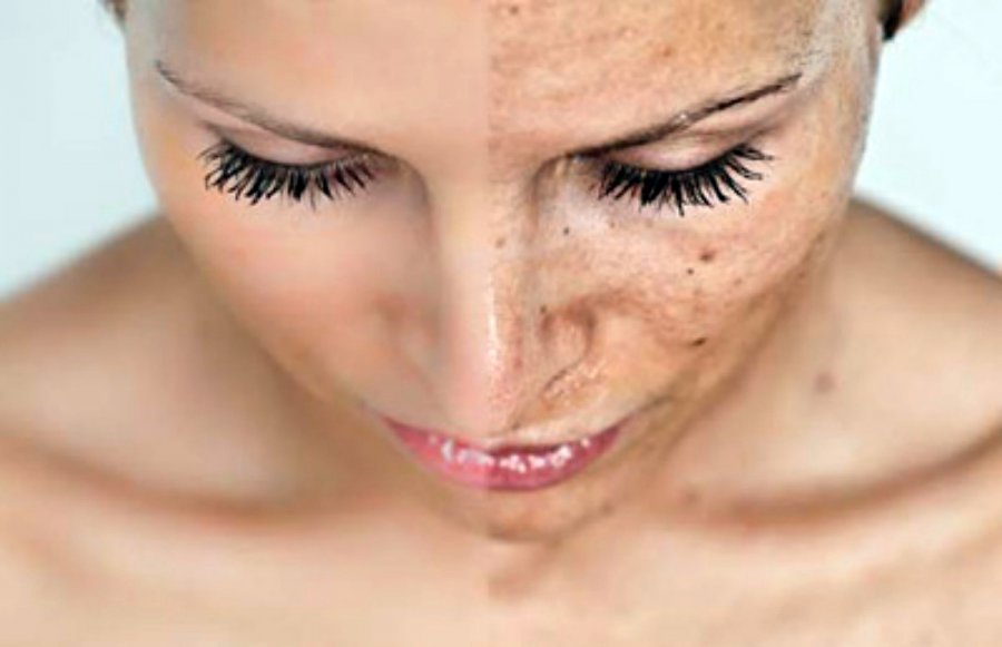 Causes de la pigmentation et comment se débarrasser des taches de vieillesse