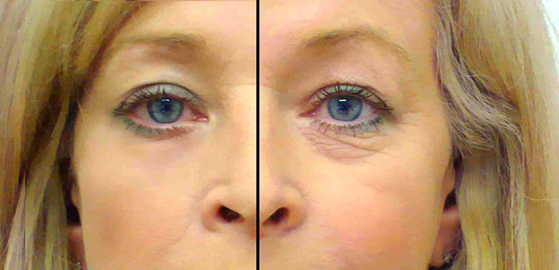 Restaurer l'élasticité de la peau à la maison