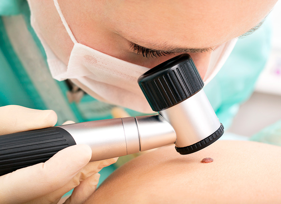 Enlèvement des grains de beauté
