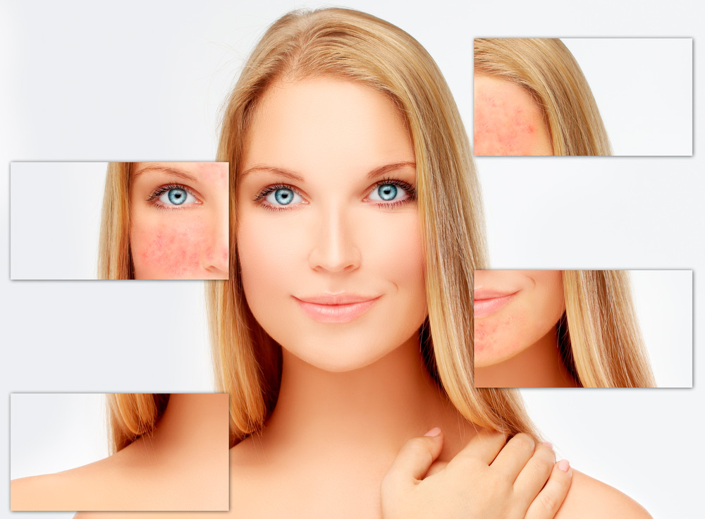 Traitement de la rosacée