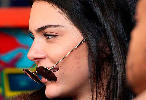 Comment Skinoren aide à traiter l'acné