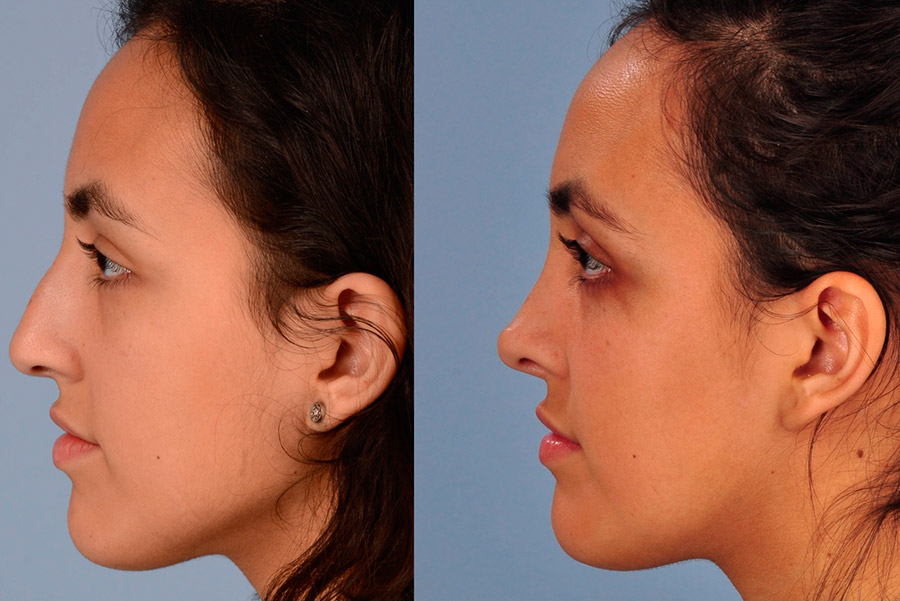 Quand faire une rhinoplastie