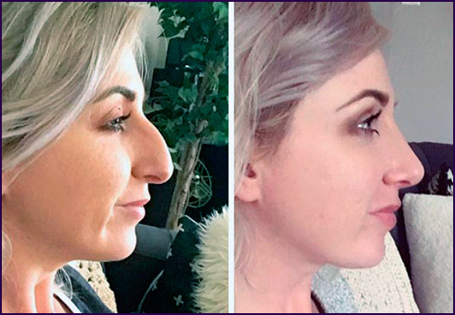 2 signes que vous pourriez avoir besoin d'une rhinoplastie